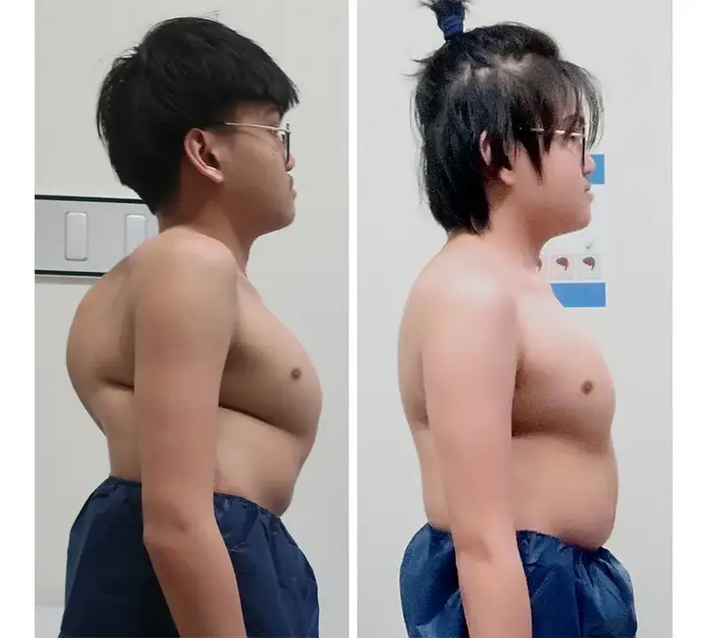 Chinno before and after surgery pictures