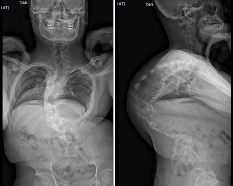 X-rays showing the severe fixed congenital curve – with 140 degrees kyphosis and 56 degrees scoliosis.