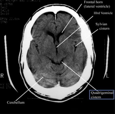 How to read a head CT scan | NewYork-Presbyterian